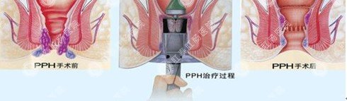 手术治疗痔疮的过程