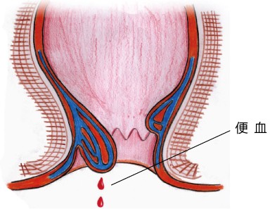 便血