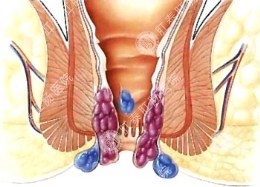 你遇到肛瘘形成的这四个步骤吗