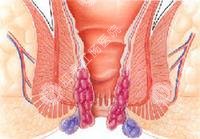 痔疮药是否是治疗痔疮专业方法？