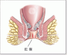 气温升高，肛裂的预防很重要