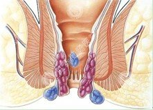 医博办法-无刀除痔手术优势