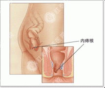 办公室治疗内痔的偏方是什么？