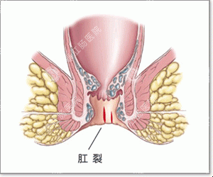 福州怎么治疗肛裂不错？