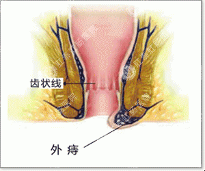 痔疮不治到底还有哪些危害呢？