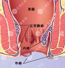 痔疮示意图