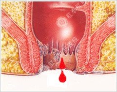 不要认为大便带血就一定是痔疮